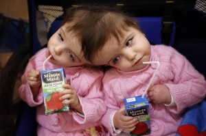 Twins who share a brain