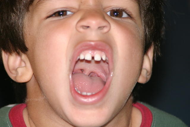 What Do Tonsils Look Like - Some Interesting Facts