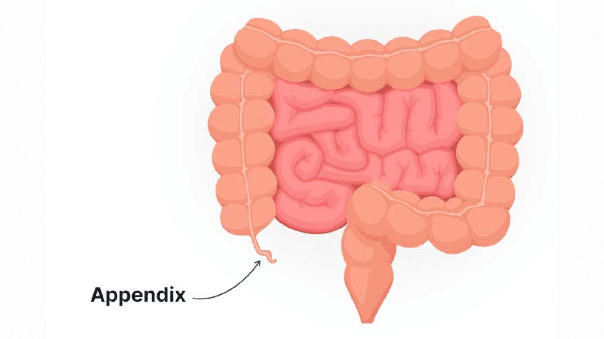 The_Appendix_is_Mostly_Useless