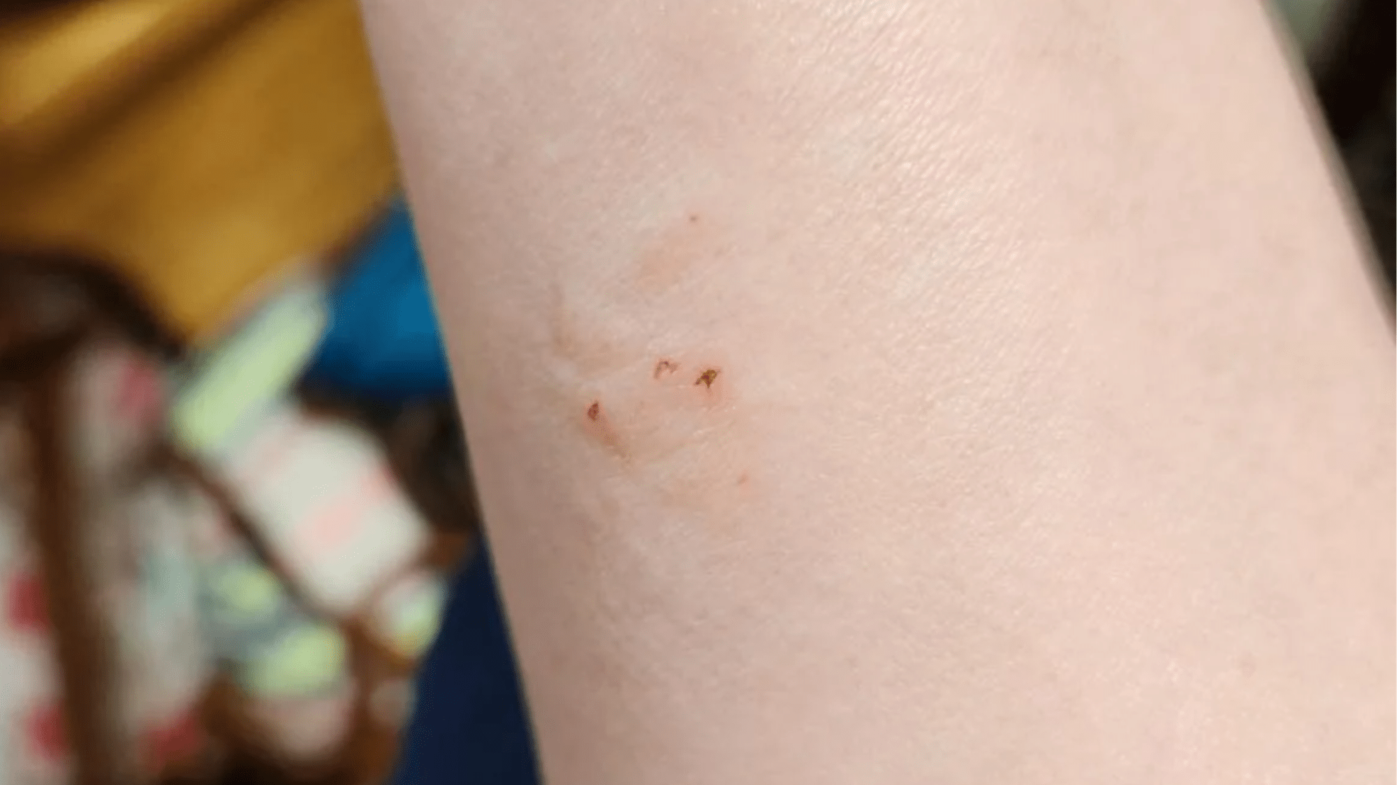 Appearance of a Bat Bite
